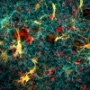 An illustration of confocal cancer cells and fibroblasts in collagen